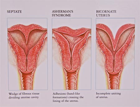 Three Types of Uterine Pathology