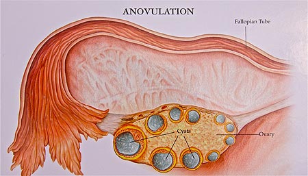 Treatment of Ovulatory Disorders Ovulation