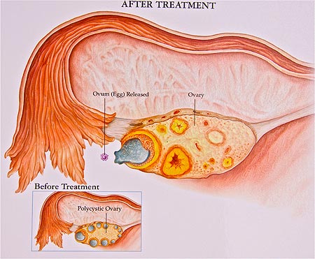 Treatment of Ovulatory Disorders Ovulation