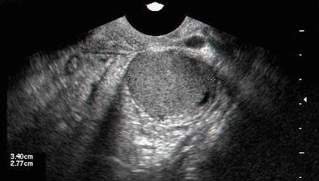Ovarian Cyst with Endometrioma