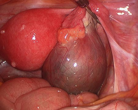 Laparoscopic Picture of Ovarian Cyst