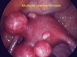 Subserosal Uterine Fibroids