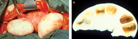 Surgical Photos of Polycycstic Ovarian Disease