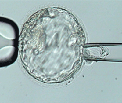 Trophectoderm Biopsy during IVF