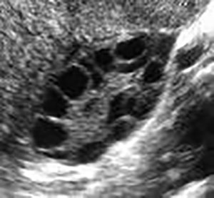 Ultrasound of Polycystic Ovary
