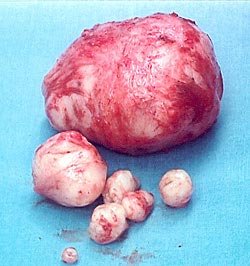 Uterine Fibroids Removed by Myomectomy